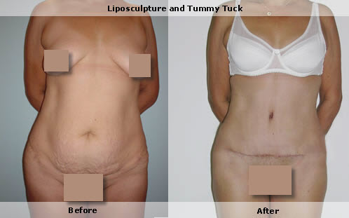 excess skin removed with tummy tuck